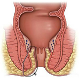 ayurvedic treatment for Fistula in Bhuj - Kutch