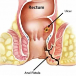 How to Heal Fistula Naturally with Ayurvedic Treatment