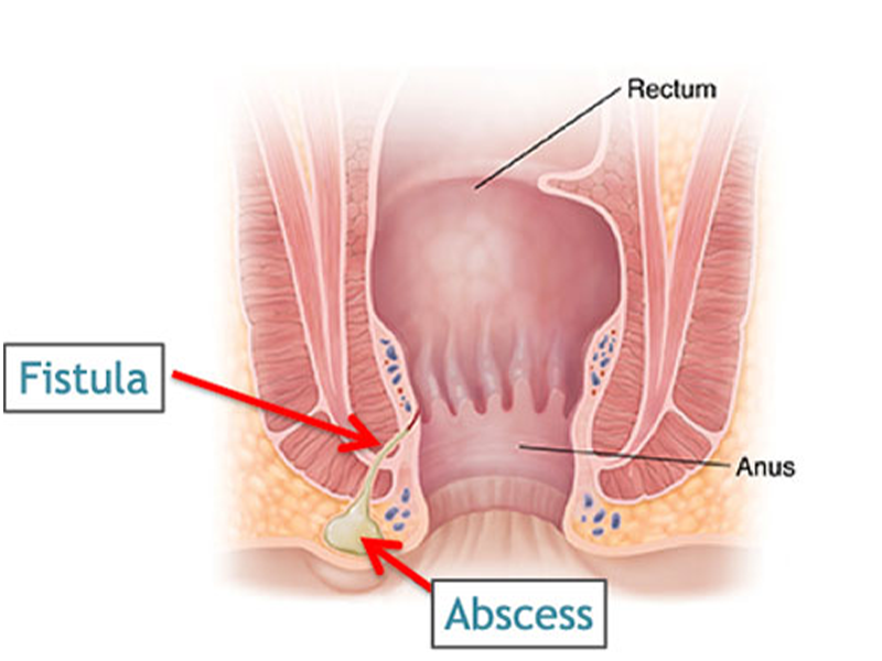 fistula