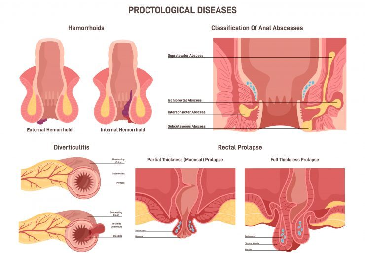 Proctological diseases set. Large intestine and rectum disorders