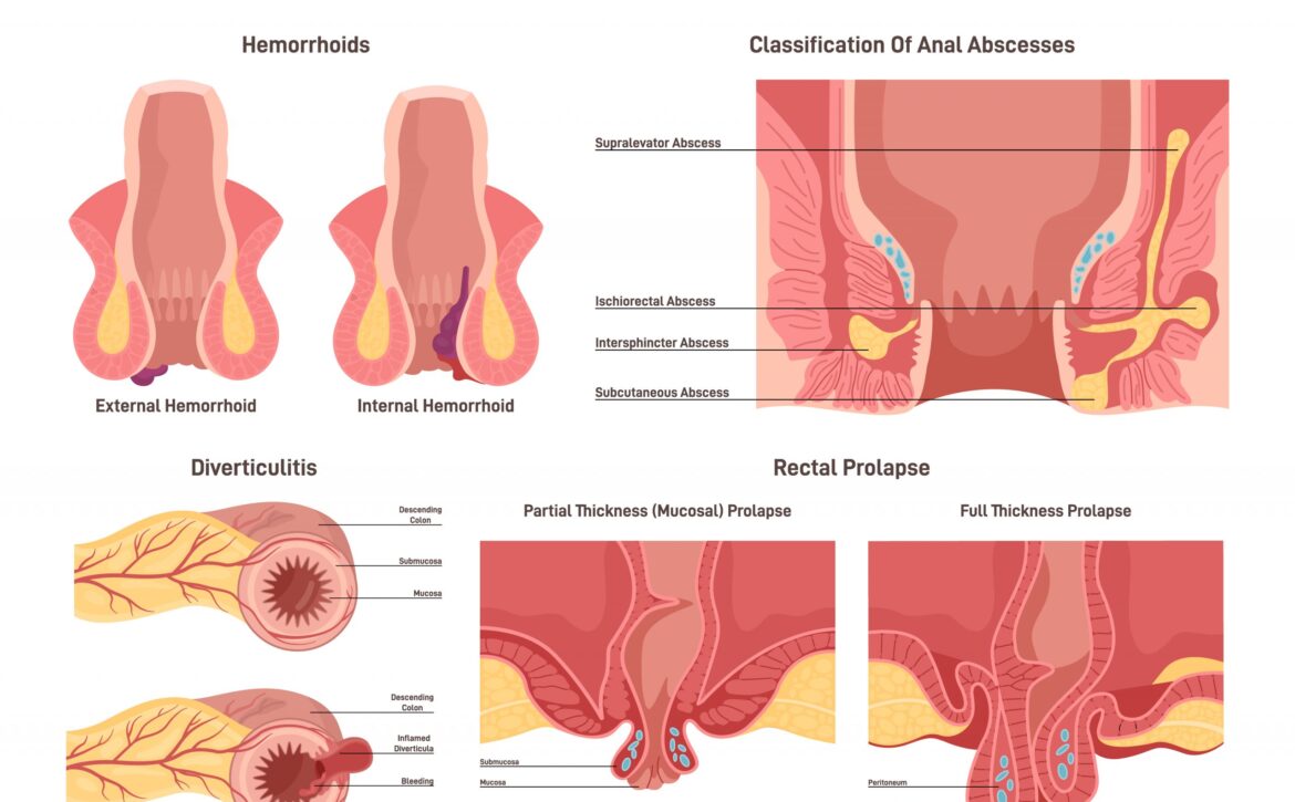 Proctological diseases set. Large intestine and rectum disorders