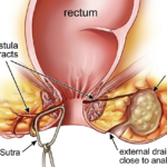 Can Ayurveda Cure Fissure Without Surgery? What to Expect From an Ayurvedic Specialist